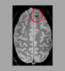 MRI scan of a brain with a Hypoxic injury.