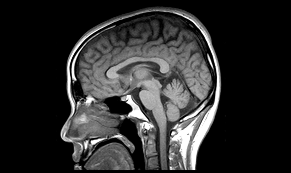 What is a Traumatic Brain Injury (TBI)?